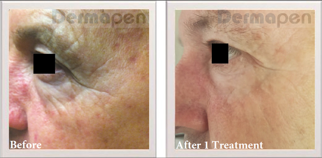 Dermapen Treatment Adelaide - Skin Rejuvenation In Adelaide