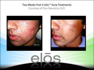 Cystic Acne Treatment - before and after