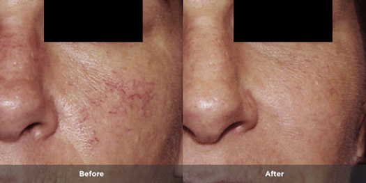 Close up of a persons face showing before and after rosacea treatment