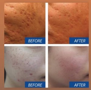 Derma Needling progress photo showing before and after treatment on acne scars on face