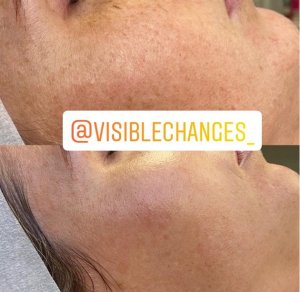 Derma Skin Needling before and after photo shwoing less skin pigmentation