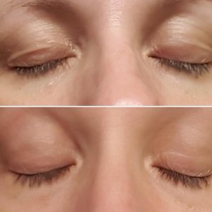 Derma Skin Needling before and after showing tighter skin on ladies face
