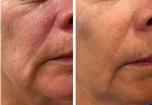 A before and after HIFU treatment photo of a ladies face