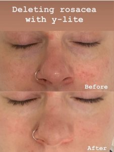 Y-lite laser Rosacea treatment before and after photo of treating face for Rosacea