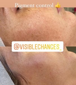 Y-lite laser before and after photo on persons face for pigment control