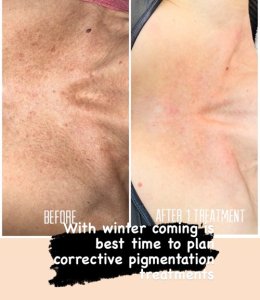 Y-lite laser before and after photo on persons neck for pigment control after 1 treatment