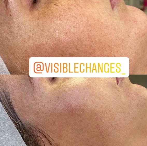 Skin Needling with Dermapen